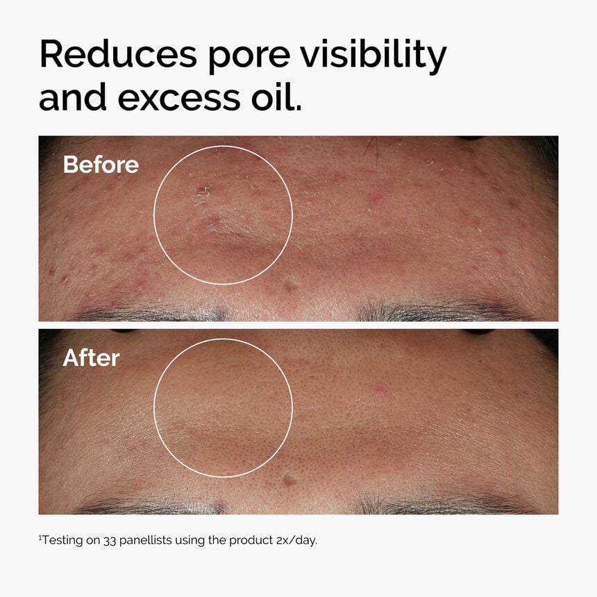 Orignal Niacinamide 10% + Zinc 1%